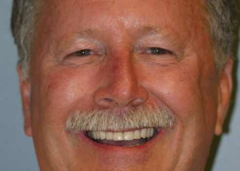 Case ron after query